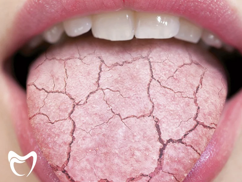 خشکی دهان؛ بررسی دلایل رایج و درمان های تخصصی