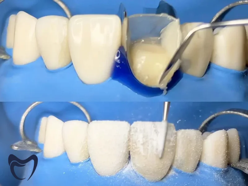 کامپوزیت لیرینگ چه تفاوتی با کامپوزیت معمولی دارد؟