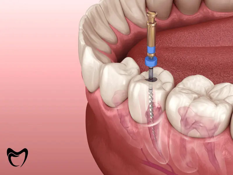 چرا عصب کشی اولیه دندان ممکن است با شکست مواجه شود