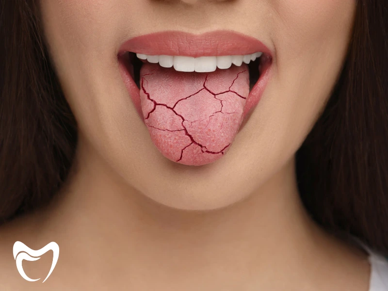 خشکی دهان چیست و چگونه ایجاد می شود