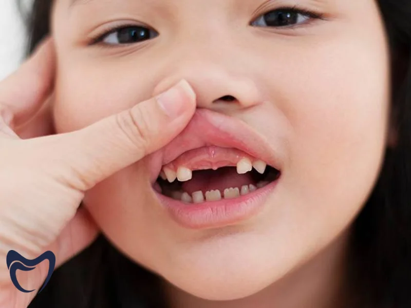 چگونه سیاه شدن لثه کودک را تشخیص دهیم؟