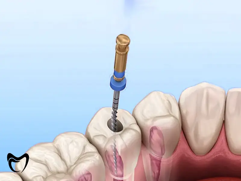 مزایا و معایب عصب کشی مجدد دندان نسبت به کشیدن دندان