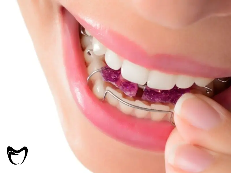 انواع پلاک های ارتودنسی متحرک و کاربرد هرکدام