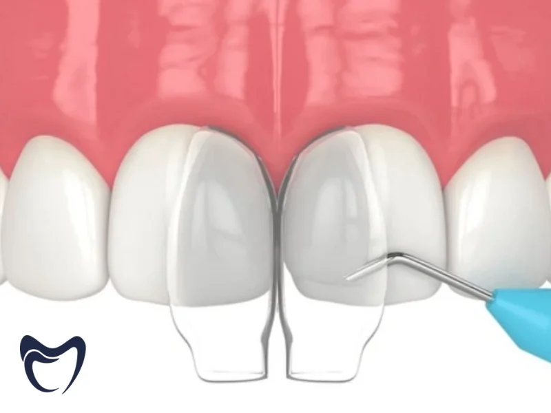 مراحل انجام کامپوزیت لیرینگ در مطب