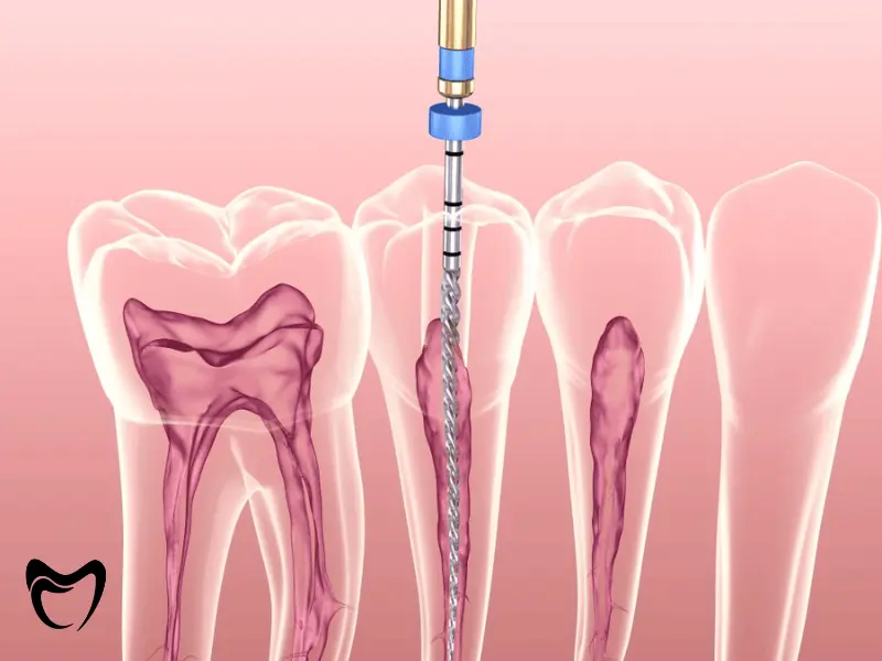 در چه شرایطی عصب کشی مجدد دندان گزینه مناسبی نیست