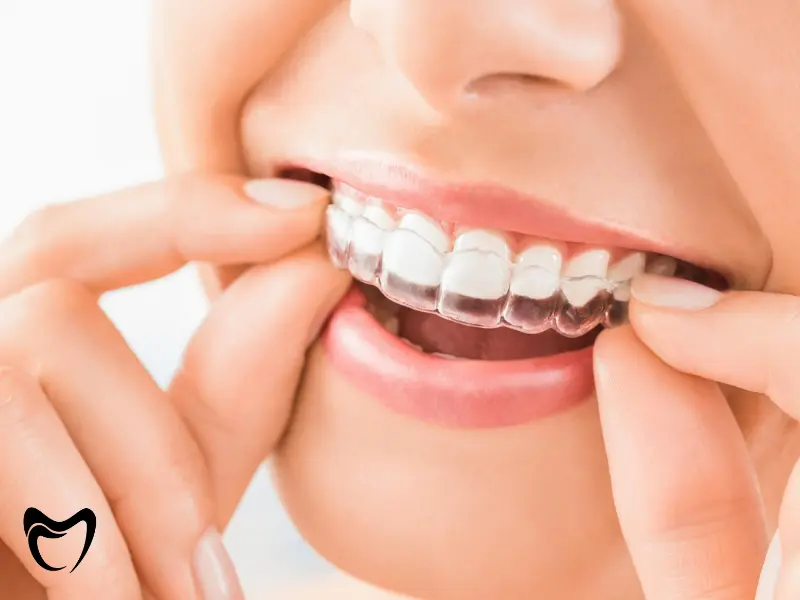 هزینه ارتودنسی متحرک به چه عواملی بستگی دارد؟