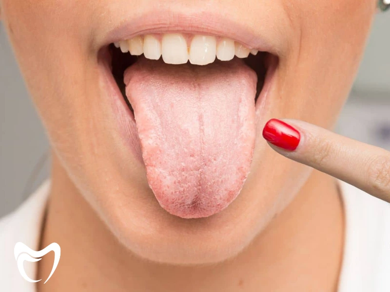 درمان های تخصصی برای خشکی دهان