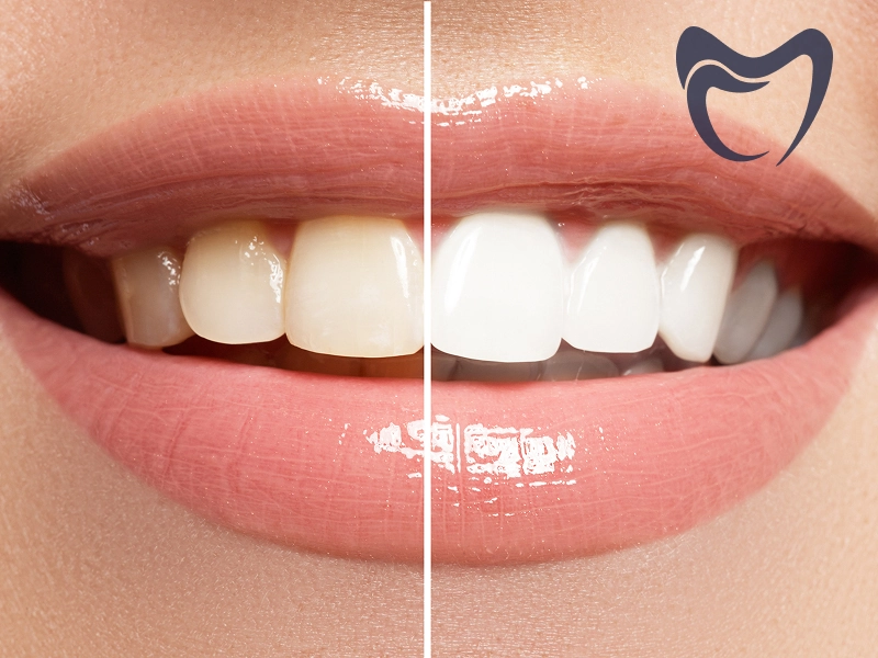 بلیچینگ دندان