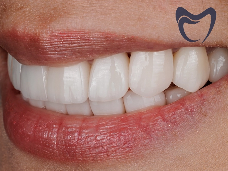 مراقبت از لمینت دندان