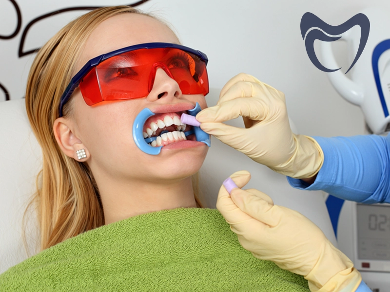 قیمت بلیچینگ دندان در تهران چقدر است؟