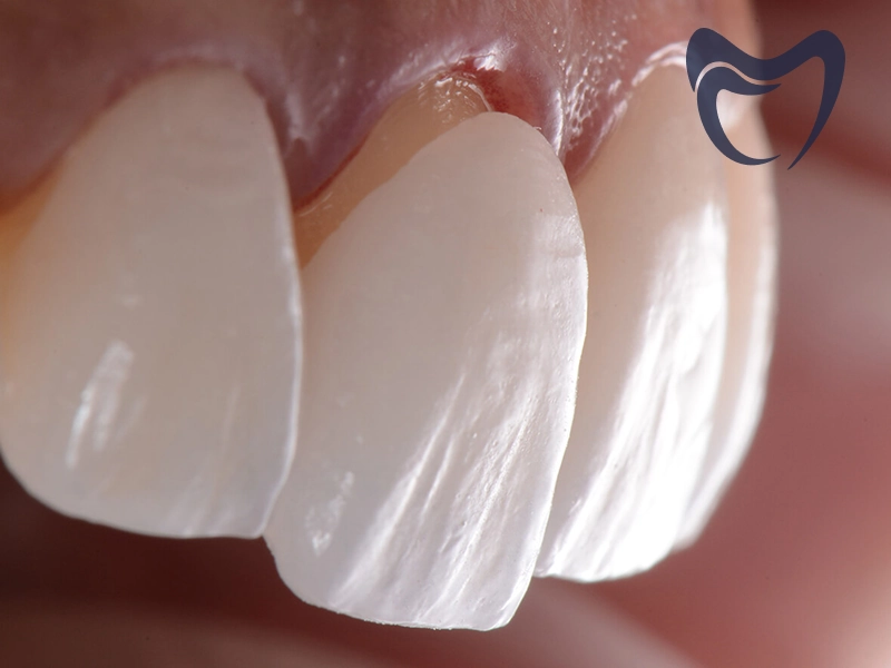 لمینت دندان چقدر دوام دارد؟