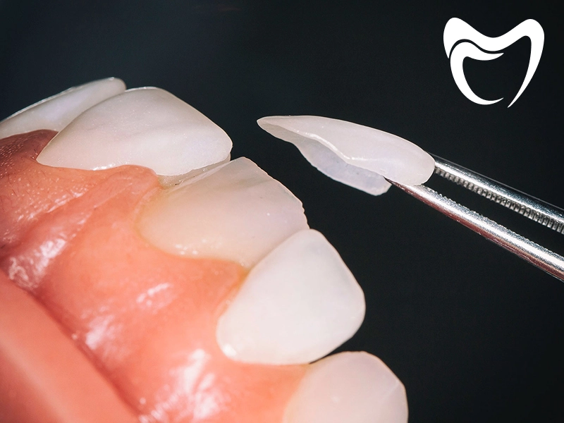 انواع لمینت دندان