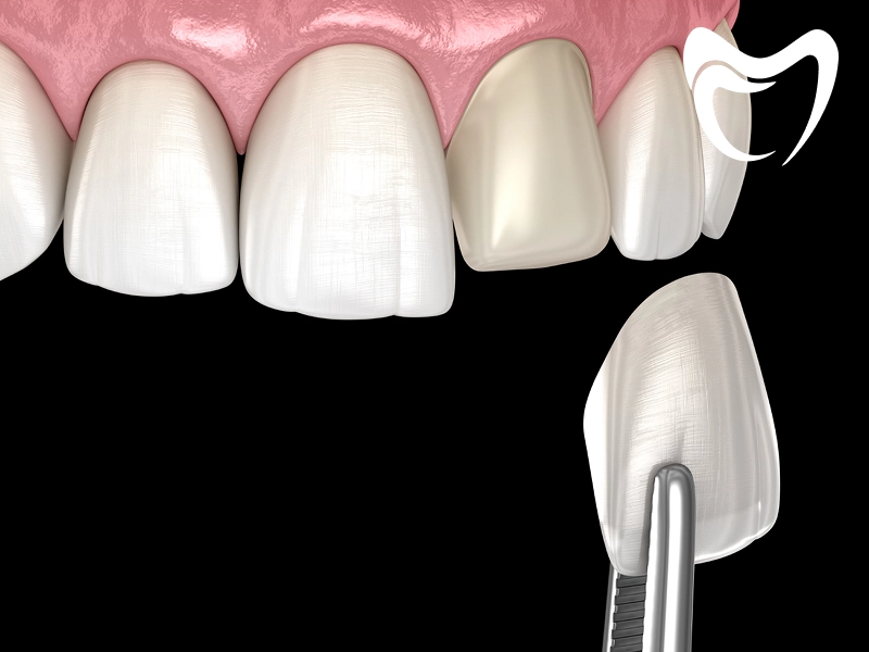 فرآیند انجام لمینت دندان