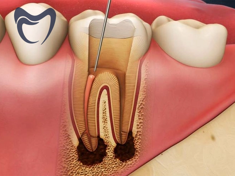 آیا عصب کشی دندان درد دارد؟