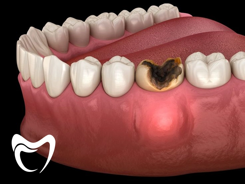 عصب کشی دندان چقدر طول میکشد؟