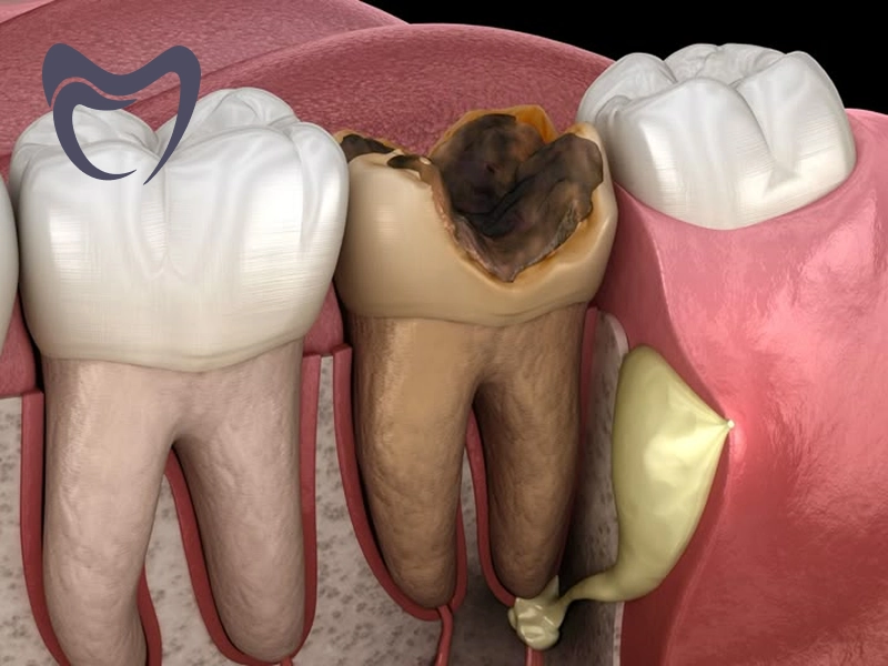 مزایا و معایب عصب کشی دندان