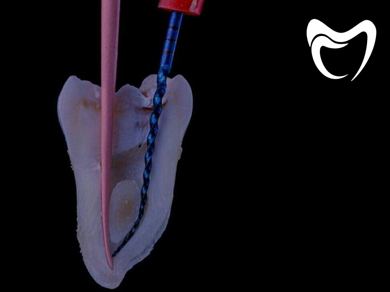 هزینه عصب کشی دندان