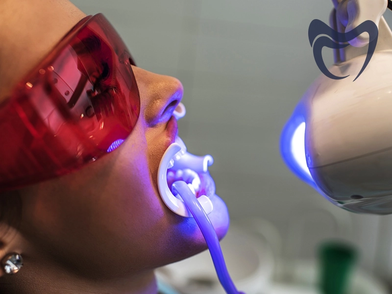 مزایای بلیچینگ دندان