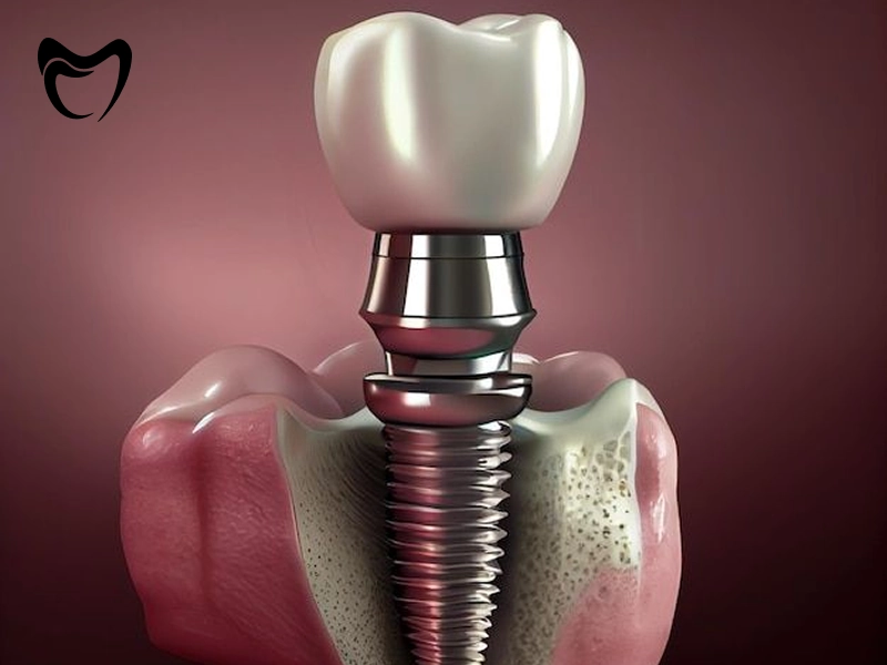 راه های کاهش درد ایمپلنت دندان