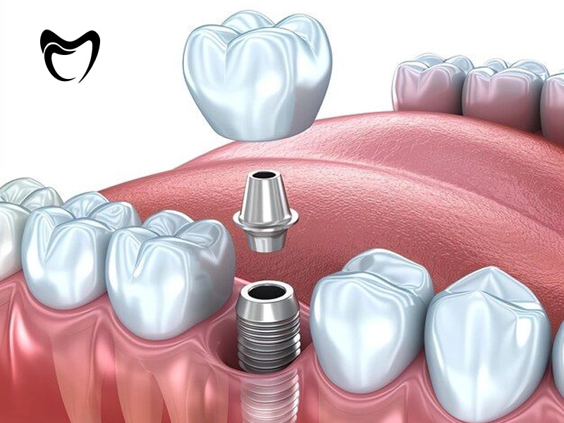 مراحل ایمپلنت دندان با قیمت