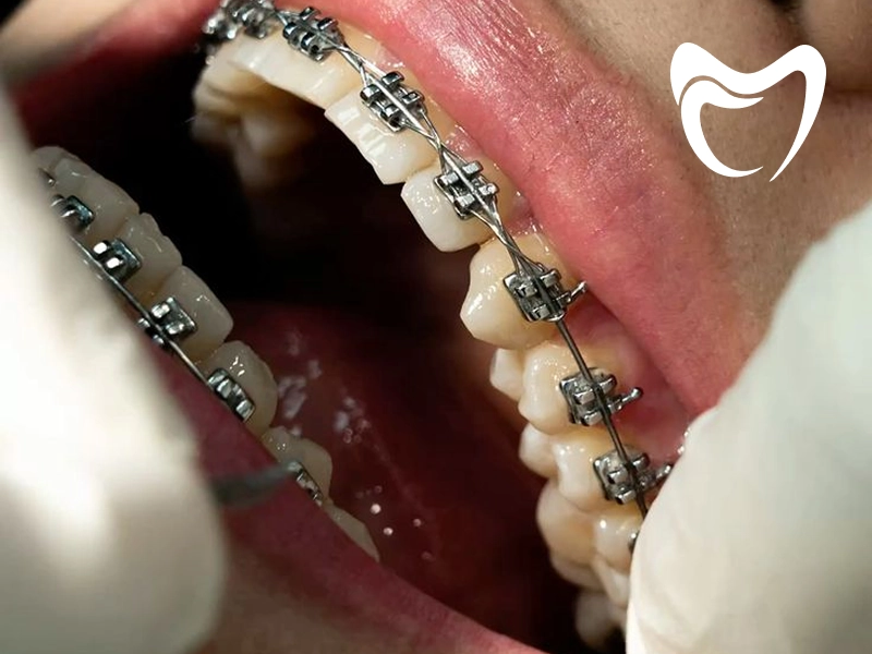 ارتودنسی ثابت