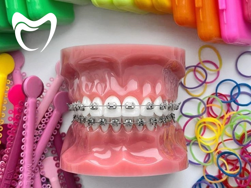 بهترین رنگ ارتودنسی چیست؟