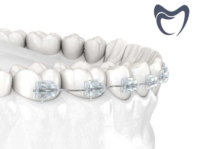 قیمت ارتودنسی دندان های جلو