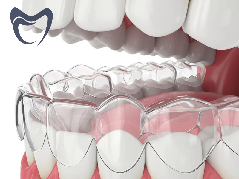 عوامل مؤثر بر هزینه ارتودنسی دندان