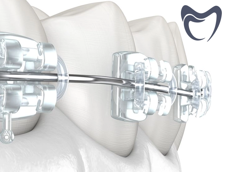 مزایای ارتودنسی