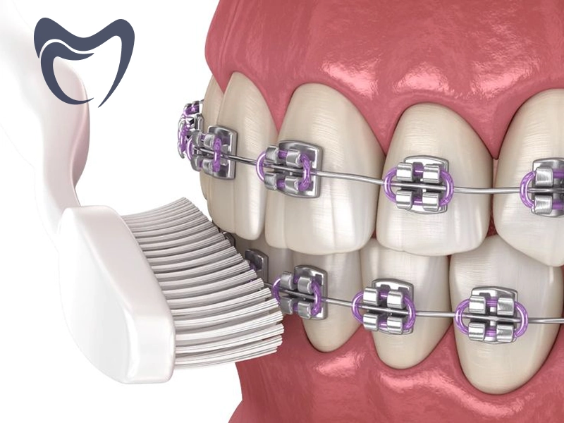 هزینه های نگهداری پس از ارتودنسی